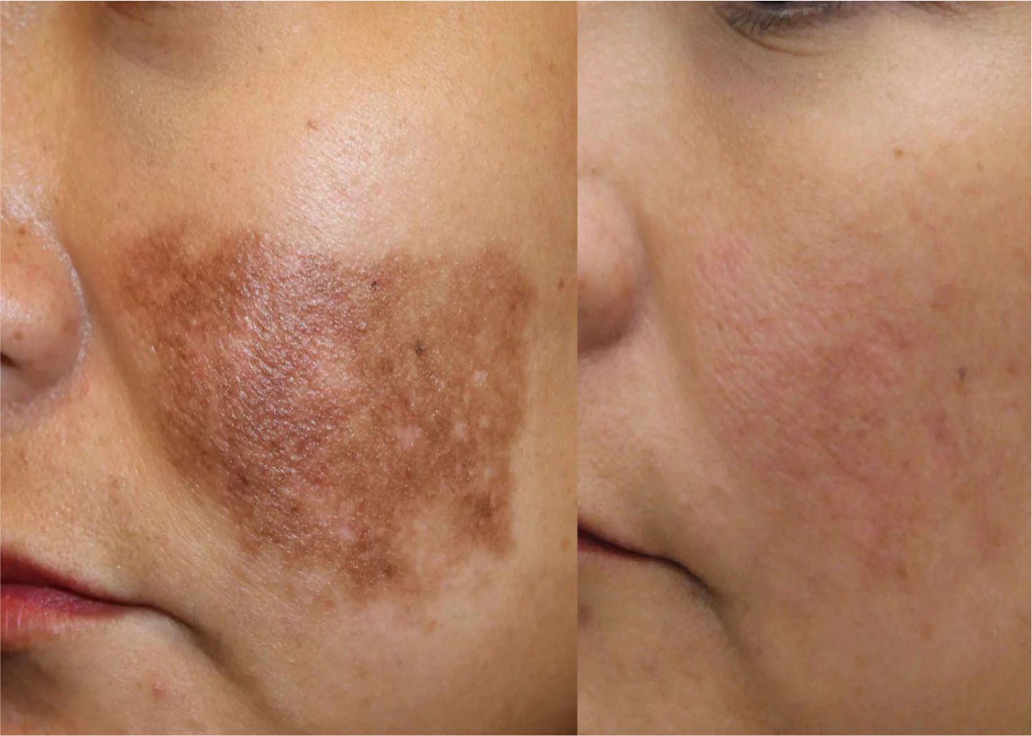 How_to_remove_pigmentation_permenentaly_1501x1071_crop_center