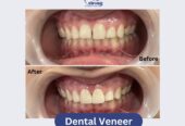 Dental-Veneer-3