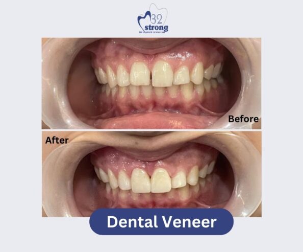 Dental-Veneer-3